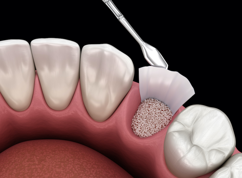 An example of what a bone graft looks like prior to the dental implant