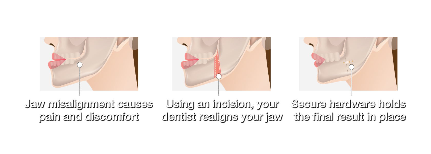 An image showing how corrective jaw surgery realigns the jaw for a more appeasing look and to help the patient with things like chewing.